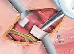 تشريح العضلات المقربة وأوتار الركبة في الورك التشنجي