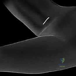 تأثير الشلل الدماغي على مفصل الورك وتطور الخلع التشنجي