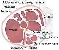 تحرير وإطالة أوتار الركبة القريبة لمنع خلع الورك
