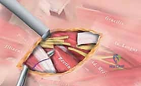 الخطوات الجراحية لإطالة العضلات المقربة في الفخذ