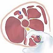 Proximal Hamstring and Adductor Lengthening for Spastic Hip Subluxation: An Intraoperative Masterclass