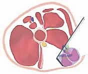 صورة توضيحية لـ إطالة أوتار الركبة والعضلات المقربة لعلاج خلع الورك التشنجي: دليل شامل للمرضى