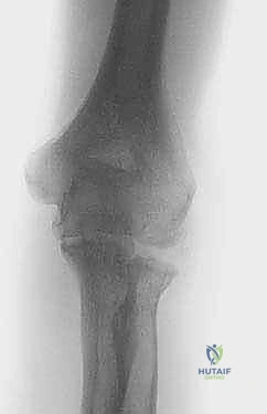 Illustration of ulnohumeral outerbridgekashiwagi arthroplasty - Dr. Mohammed Hutaif