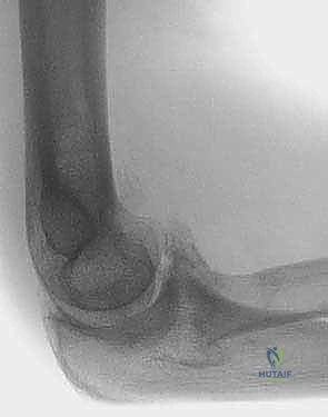 التشخيص الدقيق لخشونة الكوع بالأشعة المقطعية
