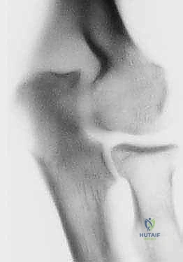 صورة توضيحية لـ جراحة مفصل الكوع بالمنظار (أوتبيردج-كاشيواجي): استعادة حركة الكوع في صنعاء مع الأستاذ الدكتور محمد هطيف