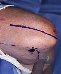 صورة توضيحية لـ جراحة مفصل الكوع بالمنظار (أوتبيردج-كاشيواجي): استعادة حركة الكوع في صنعاء مع الأستاذ الدكتور محمد هطيف