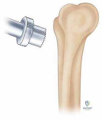 جراحة مفصل الكوع بالمنظار (أوتبيردج-كاشيواجي): استعادة حركة الكوع في صنعاء مع الأستاذ الدكتور محمد هطيف