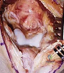 تشريح مفصل الكوع والنتوءات العظمية