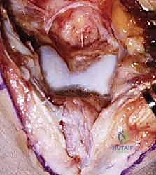 تكون الأجسام الحرة داخل مفصل الكوع