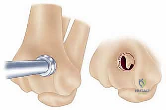 أعراض خشونة مفصل الكوع وتأثيرها على الحركة
