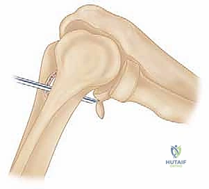 صورة توضيحية لـ جراحة مفصل الكوع بالمنظار (أوتبيردج-كاشيواجي): استعادة حركة الكوع في صنعاء مع الأستاذ الدكتور محمد هطيف