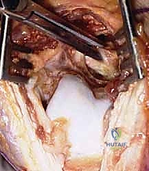 صورة توضيحية لـ جراحة مفصل الكوع بالمنظار (أوتبيردج-كاشيواجي): استعادة حركة الكوع في صنعاء مع الأستاذ الدكتور محمد هطيف