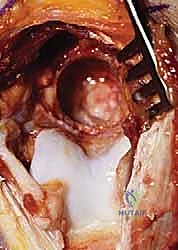 صورة توضيحية لـ جراحة مفصل الكوع بالمنظار (أوتبيردج-كاشيواجي): استعادة حركة الكوع في صنعاء مع الأستاذ الدكتور محمد هطيف