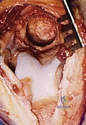 صورة توضيحية لـ جراحة مفصل الكوع بالمنظار (أوتبيردج-كاشيواجي): استعادة حركة الكوع في صنعاء مع الأستاذ الدكتور محمد هطيف