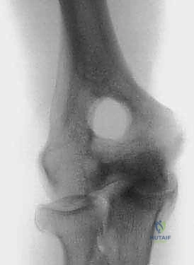 صورة توضيحية لـ جراحة مفصل الكوع بالمنظار (أوتبيردج-كاشيواجي): استعادة حركة الكوع في صنعاء مع الأستاذ الدكتور محمد هطيف