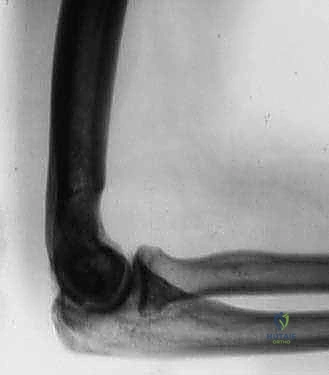 صورة توضيحية لـ جراحة مفصل الكوع بالمنظار (أوتبيردج-كاشيواجي): استعادة حركة الكوع في صنعاء مع الأستاذ الدكتور محمد هطيف