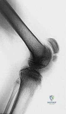 مقارنة بين المشية الطبيعية ومشية الانحناء