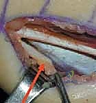 خطوات إطالة العضلة نصف الوترية