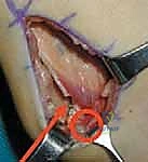 إطالة العضلة نصف الغشائية