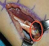 إغلاق الشقوق الجراحية والخياطة التجميلية