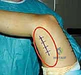 تشريح العضلة المستقيمة الفخذية