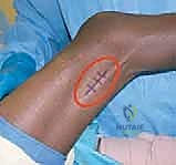 توضيح لآليات الشلل الدماغي وتأثيره على العضلات