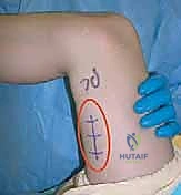 تحليل المشي ثلاثي الأبعاد