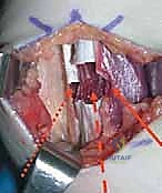 عزل وتر العضلة المستقيمة الفخذية