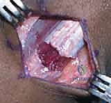 الفحص السريري لتقييم مشية الانحناء