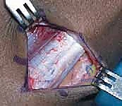 صورة توضيحية لـ إطالة أوتار الركبة ونقل العضلة المستقيمة الفخذية لعلاج مشية الانحناء في الشلل الدماغي: دليل شامل للمرضى مع الأستاذ الدكتور محمد هطيف