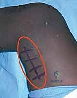 صورة توضيحية لـ إطالة أوتار الركبة ونقل العضلة المستقيمة الفخذية لعلاج مشية الانحناء في الشلل الدماغي: دليل شامل للمرضى مع الأستاذ الدكتور محمد هطيف