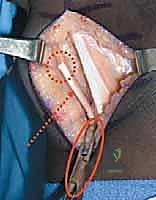 صورة توضيحية لـ إطالة أوتار الركبة ونقل العضلة المستقيمة الفخذية لعلاج مشية الانحناء في الشلل الدماغي: دليل شامل للمرضى مع الأستاذ الدكتور محمد هطيف