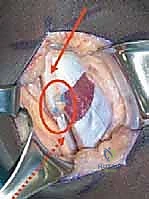 صورة توضيحية لـ إطالة أوتار الركبة ونقل العضلة المستقيمة الفخذية لعلاج مشية الانحناء في الشلل الدماغي: دليل شامل للمرضى مع الأستاذ الدكتور محمد هطيف