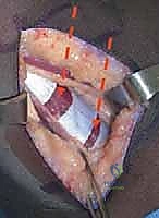 تمرير ونقل وتر المستقيمة الفخذية