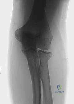 Illustration of continuous passive motion - Dr. Mohammed Hutaif