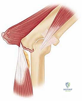 صورة توضيحية لـ تحرير تيبس المرفق بتقنية العمود الجانبي: استعادة حركة ذراعك مع الأستاذ الدكتور محمد هطيف