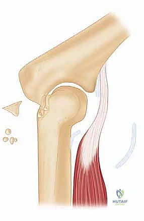 التشريح المعقد لمفصل المرفق والأربطة المحيطة