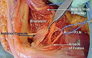 خطوات جراحة تحرير العمود الجانبي للمرفق