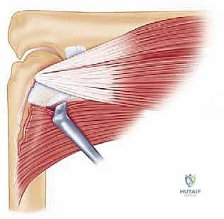 الأشعة المقطعية والتشخيص الدقيق لتيبس المرفق