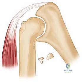 إزالة الأنسجة المتليفة والكبسولة الأمامية
