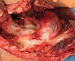 تنظيف الحفرة الزجية واستعادة المدى الحركي