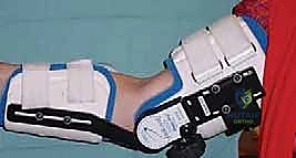 تحرير تيبس المرفق بتقنية العمود الجانبي: استعادة حركة ذراعك مع الأستاذ الدكتور محمد هطيف