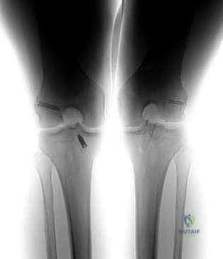 صورة توضيحية لـ إعادة بناء الرباط الصليبي الأمامي التصحيحية: حل شامل لحالات الفشل الجراحي السابق في صنعاء مع الأستاذ الدكتور محمد هطيف