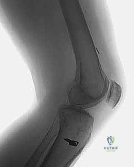 صورة توضيحية لـ إعادة بناء الرباط الصليبي الأمامي التصحيحية: حل شامل لحالات الفشل الجراحي السابق في صنعاء مع الأستاذ الدكتور محمد هطيف