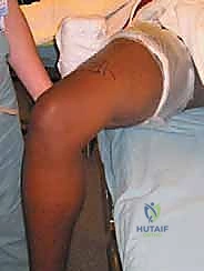 صورة توضيحية لـ إعادة بناء الرباط الصليبي الأمامي التصحيحية: حل شامل لحالات الفشل الجراحي السابق في صنعاء مع الأستاذ الدكتور محمد هطيف