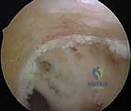 صورة توضيحية لـ إعادة بناء الرباط الصليبي الأمامي التصحيحية: حل شامل لحالات الفشل الجراحي السابق في صنعاء مع الأستاذ الدكتور محمد هطيف