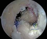 صورة توضيحية لـ إعادة بناء الرباط الصليبي الأمامي التصحيحية: حل شامل لحالات الفشل الجراحي السابق في صنعاء مع الأستاذ الدكتور محمد هطيف