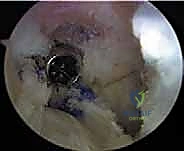 إعادة بناء الرباط الصليبي الأمامي التصحيحية: حل شامل لحالات الفشل الجراحي السابق في صنعاء مع الأستاذ الدكتور محمد هطيف