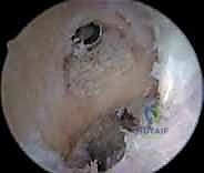 صورة توضيحية لـ إعادة بناء الرباط الصليبي الأمامي التصحيحية: حل شامل لحالات الفشل الجراحي السابق في صنعاء مع الأستاذ الدكتور محمد هطيف