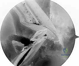 صورة توضيحية لـ إعادة بناء الرباط الصليبي الأمامي التصحيحية: حل شامل لحالات الفشل الجراحي السابق في صنعاء مع الأستاذ الدكتور محمد هطيف